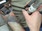 The first treatment of a tattoo removal